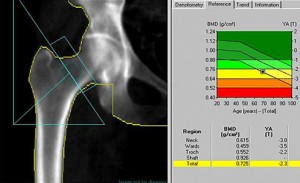 bonedensity